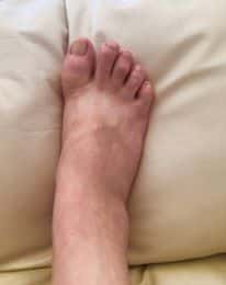 gout foot