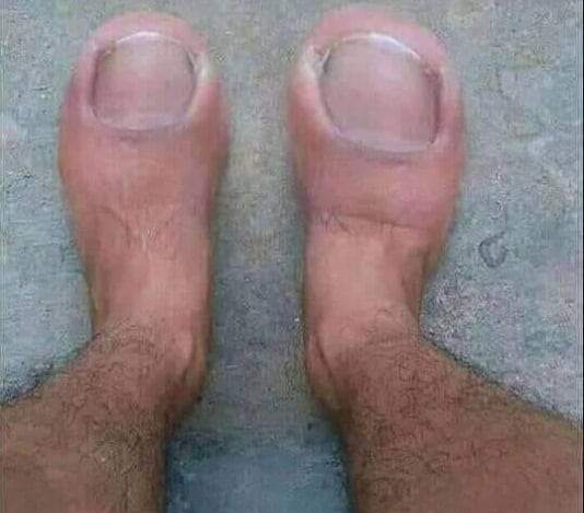 Norfolk People Evolve Just One Toe