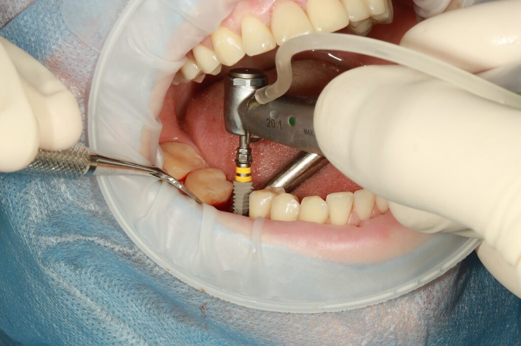 The Nature and Importance of Dental Implants