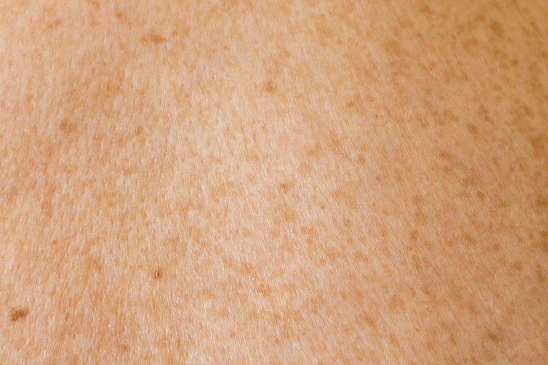 How to Identify Moles on Your Skin: What’s Normal and What’s Not