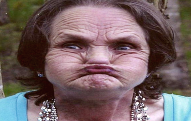 Bury St Edmunds woman’s Botox binge leaves her with “Whale Smile”