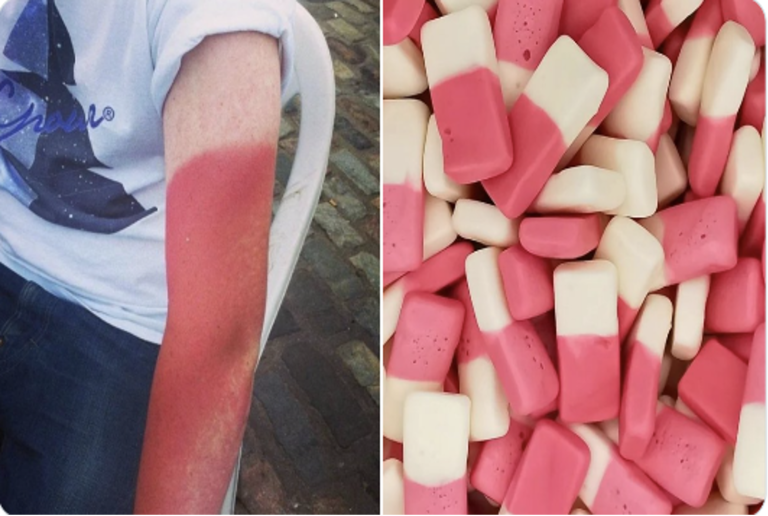 Lowestoft Teen Dubbed ‘Rhubarb’ After Heatwave Sunburn Incident